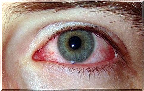 Red eyes as a sign of anxiety