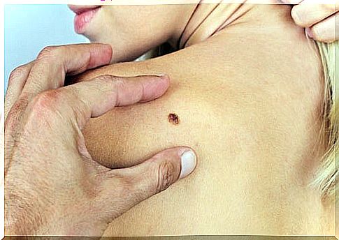 6 skin cancer symptoms you should not ignore