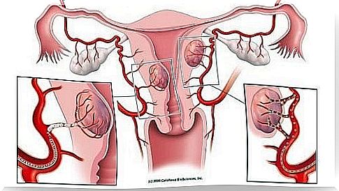 7 warning signs of fibroids you should be aware of