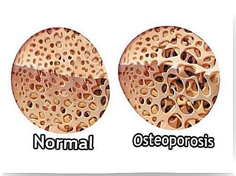 osteoporosis causes bone pain