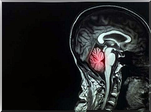 Brain metastases: Description and treatment