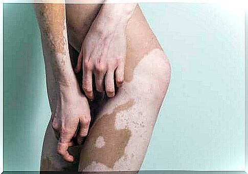 Corrective makeup can be used in cases of vitiligo