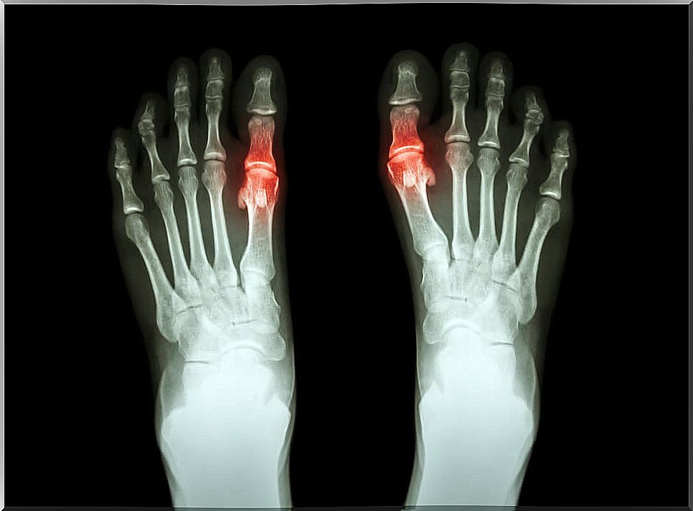 Effective natural remedies to treat arthritis