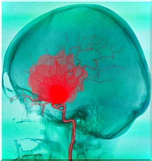 Drawing of cerebral palsy