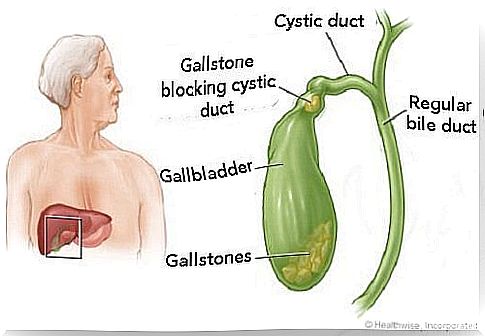 How do I know if I have gallstones?