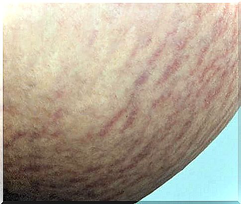 How to get rid of red and white stretch marks