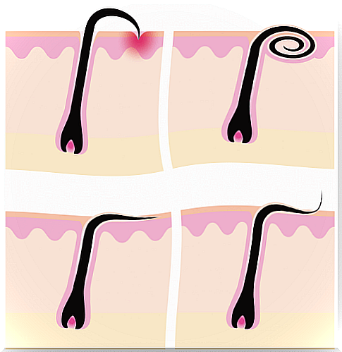 Illustration of ingrown hairs