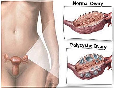 Natural remedies for polycystic ovary syndrome