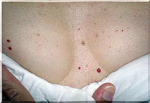 Red spots on the skin: Should you be concerned?