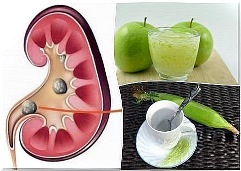 Remove kidney stones using these natural remedies