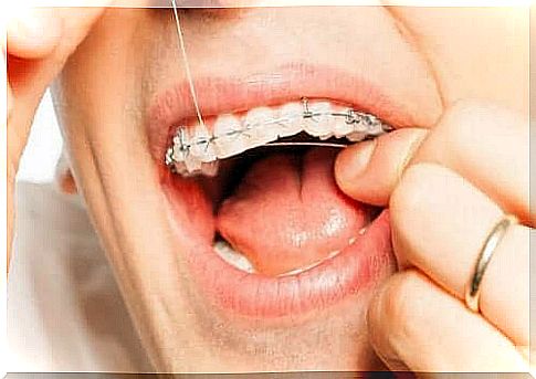 Flossing is an important part of good oral hygiene with braces