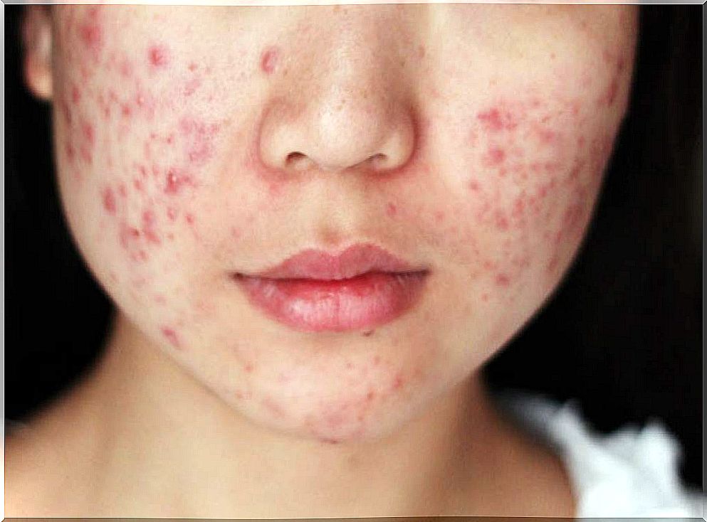 Girl with acne