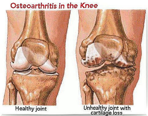 Symptoms and prevention of arthritis