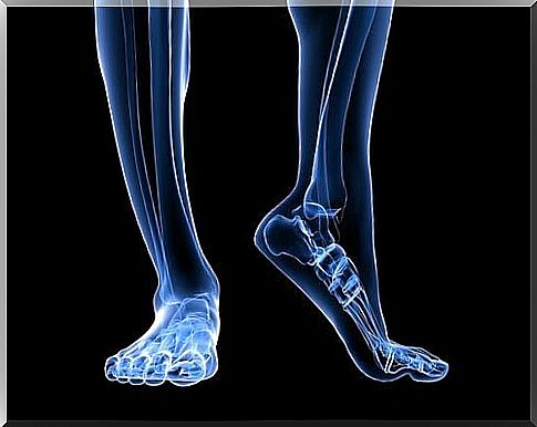 Bone in the foot shows plantar fasciitis