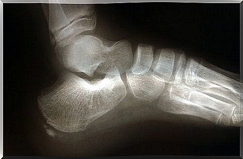 Bone in the foot shows plantar fasciitis