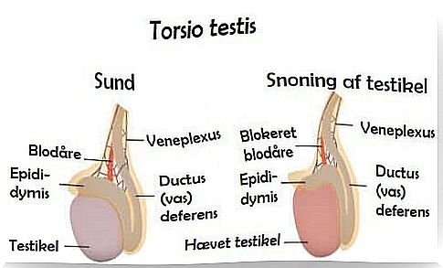 Torsio testis: Symptoms and causes