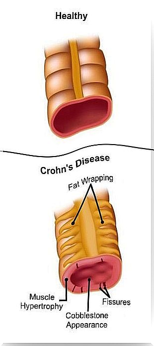 Chron's disease